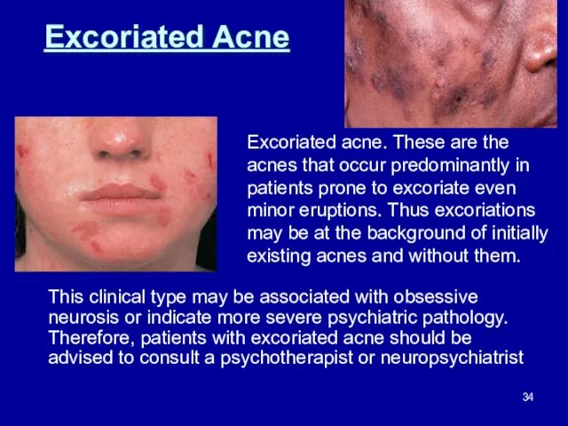 Excoriated Acne This clinical type may be associated with obsessive neurosis