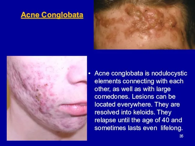 Acne Conglobata Acne conglobata is nodulocystic elements connecting with each other,