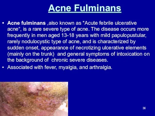 Acne Fulminans Acne fulminans ,also known as "Acute febrile ulcerative acne“,