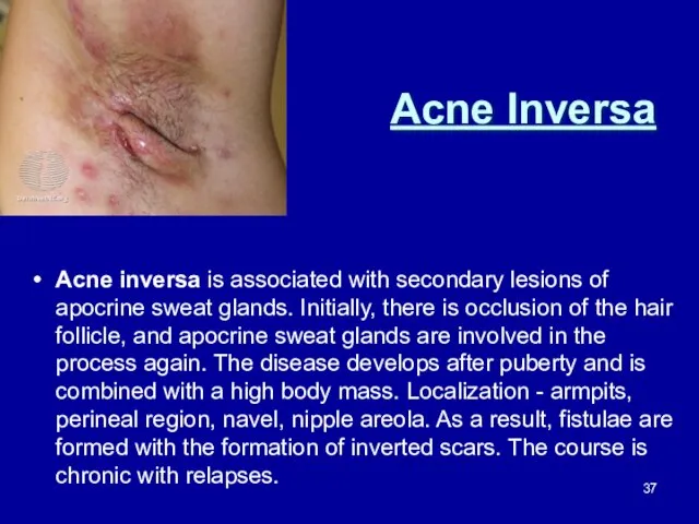 Acne Inversa Acne inversa is associated with secondary lesions of apocrine