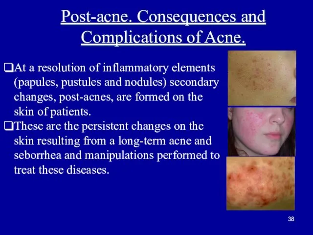 Post-acne. Consequences and Complications of Acne. At a resolution of inflammatory