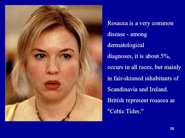 Rosacea is a very common disease - among dermatological diagnoses, it