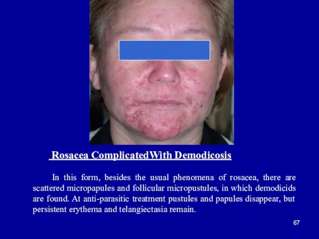 Rosacea ComplicatedWith Demodicosis In this form, besides the usual phenomena of