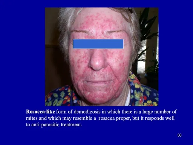 Rosacea-like form of demodicosis in which there is a large number