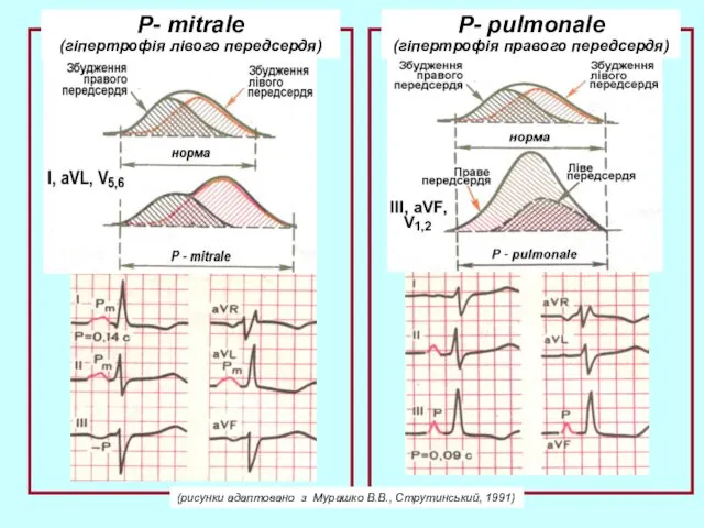 P- pulmonale (гіпертрофія правого передсердя) P- mitrale (гіпертрофія лівого передсердя) (рисунки