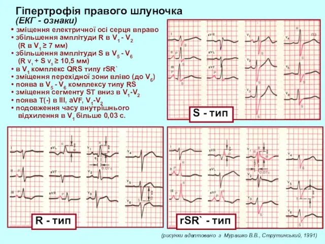 rSR` - тип S - тип R - тип Гіпертрофія правого