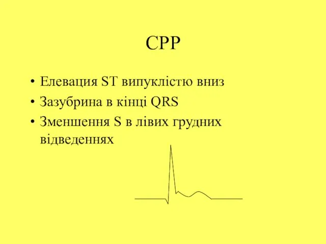 СРР Елевация ST випуклістю вниз Зазубрина в кінці QRS Зменшення S в лівих грудних відведеннях