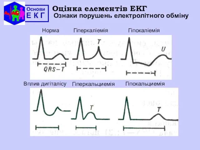 Основи Е К Г Оцінка елементів ЕКГ Ознаки порушень електролітного обміну