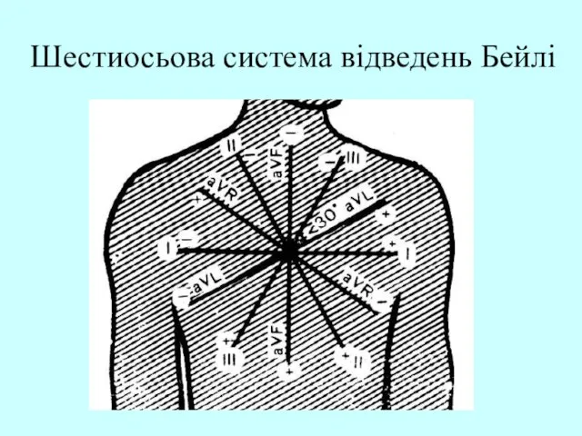 Шестиосьова система відведень Бейлі