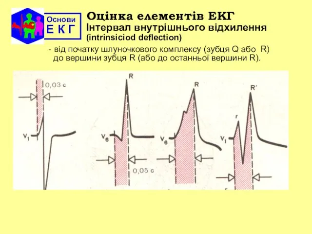 Основи Е К Г Оцінка елементів ЕКГ Інтервал внутрішнього відхилення (intrinsiciod