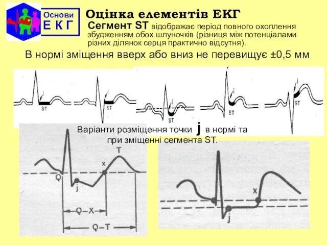 Основи Е К Г Оцінка елементів ЕКГ Cегмент ST відображає період