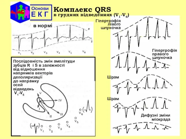 Комплекс QRS в грудних відведеннях (V1-V6) в нормі Послідовність змін амплітуди