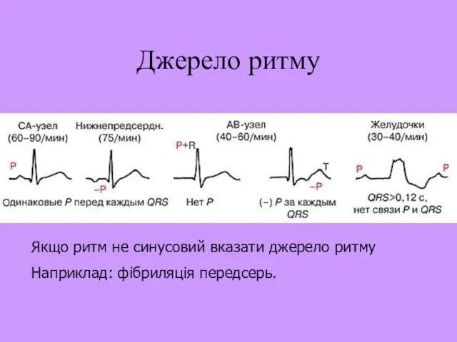 Джерело ритму Якщо ритм не синусовий вказати джерело ритму Наприклад: фібриляція передсерь.