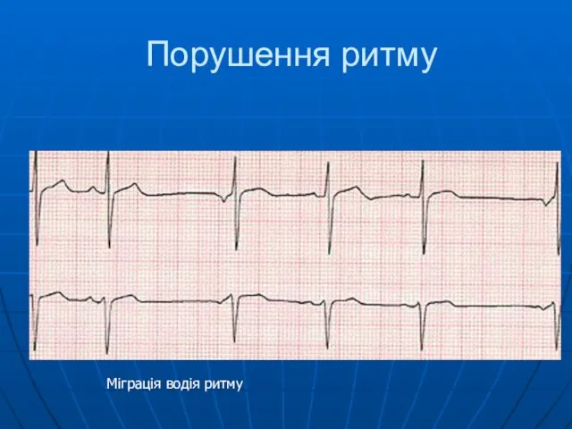 Порушення ритму Міграція водія ритму