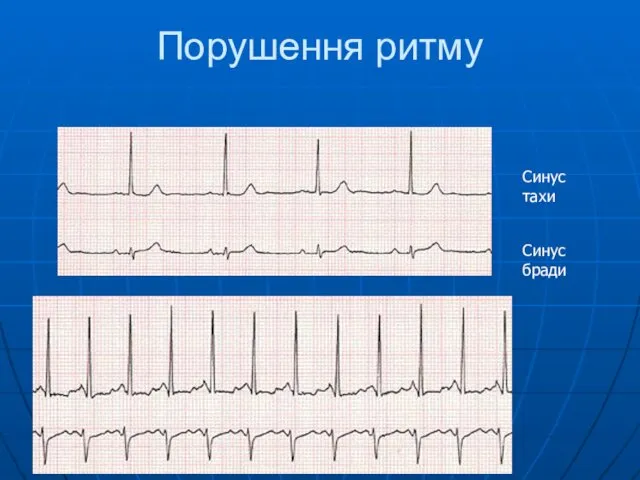 Порушення ритму Синус тахи Синус бради