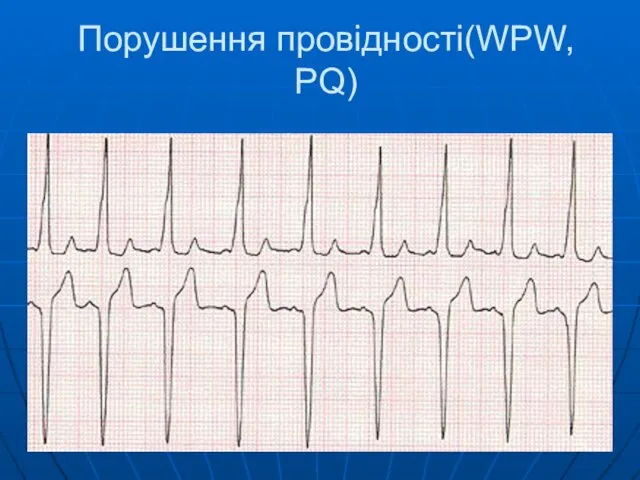 Порушення провідності(WPW, PQ)