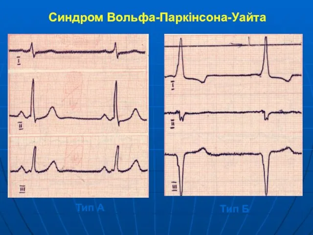 Синдром Вольфа-Паркінсона-Уайта Тип А Тип Б