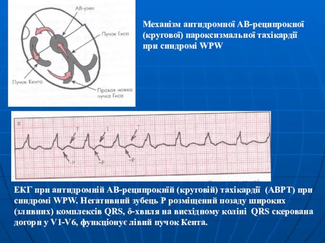 Механізм антидромної АВ-реципрокної (кругової) пароксизмальної тахікардії при синдромі WPW ЕКГ при