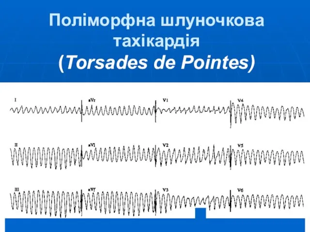 Поліморфна шлуночкова тахікардія (Torsades de Pointes)