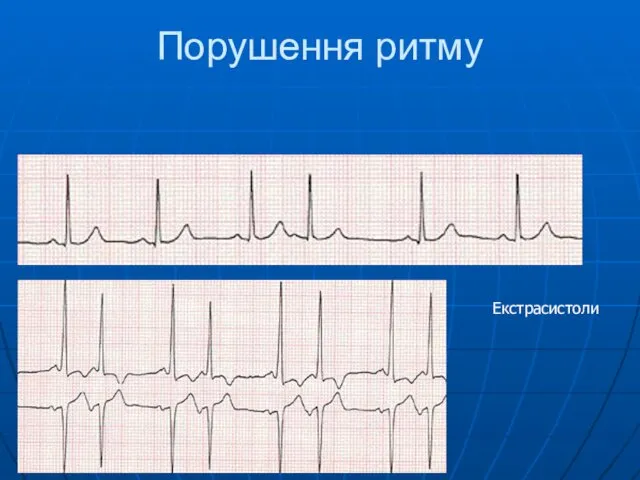 Порушення ритму Екстрасистоли