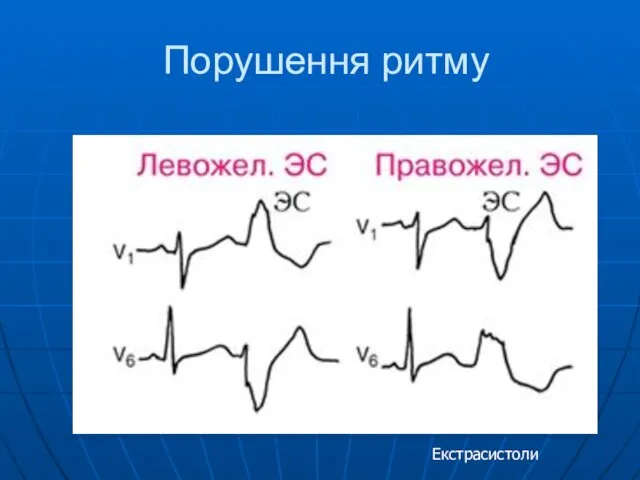 Порушення ритму Екстрасистоли