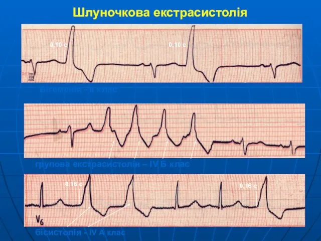 Шлуночкова екстрасистолія Бігеменія - II клас групова екстрасистолія – IV Б