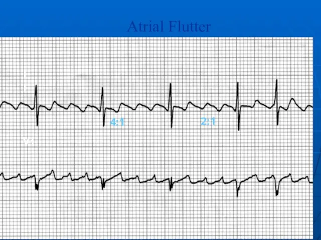 II V1 Atrial Flutter 4:1 2:1