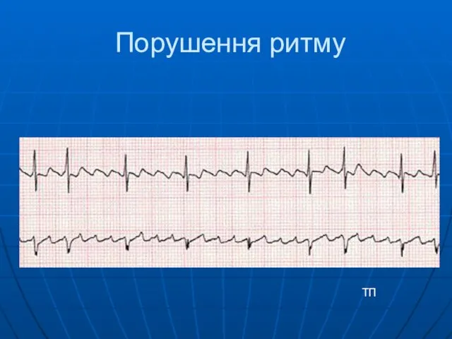 Порушення ритму ТП