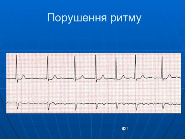 Порушення ритму ФП