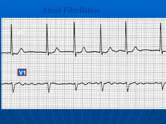 V5 Atrial Fibrillation V1