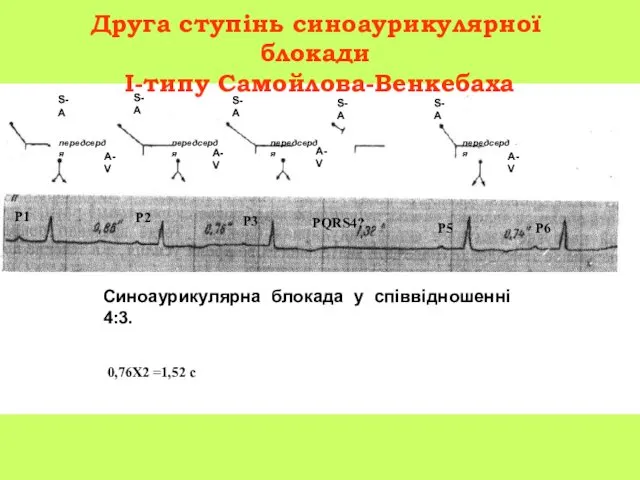 Друга ступінь синоаурикулярної блокади I-типу Самойлова-Венкебаха передсердя передсердя передсердя передсердя S-A