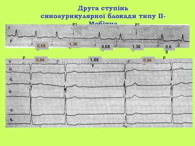 Друга ступінь синоаурикулярної блокади типу II- Мобітца 0,94” 1,88” 0,68” 1,36”