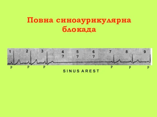 Повна синоаурикулярна блокада S I N U S A R E