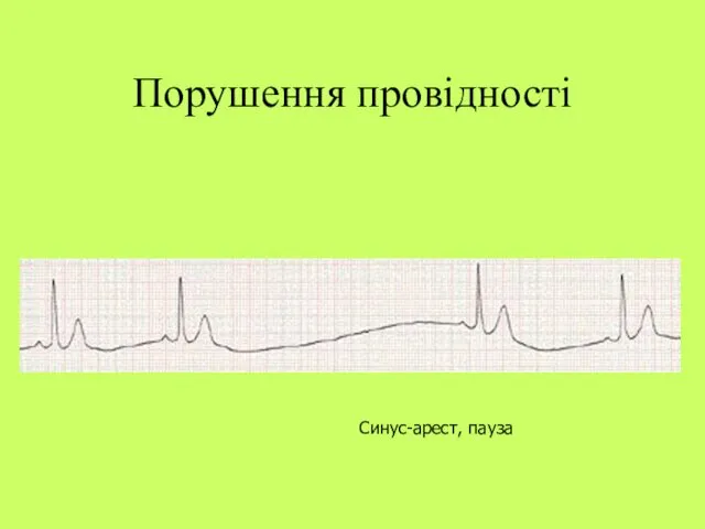 Порушення провідності Синус-арест, пауза