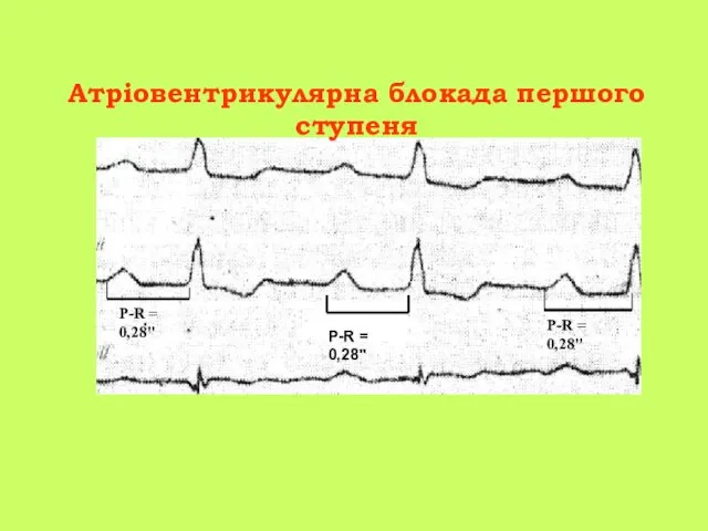 Атріовентрикулярна блокада першого ступеня P-R = 0,28" P-R = 0,28" P-R = 0,28"