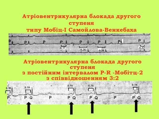 Атріовентрикулярна блокада другого ступеня типу Мобіц-I Самойлова-Венкебаха 0,17" 0,36" 0,38" 0,17"