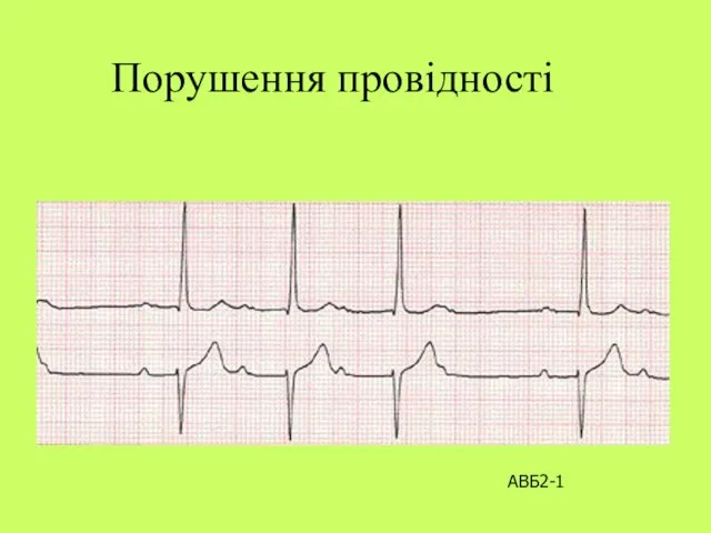 Порушення провідності АВБ2-1