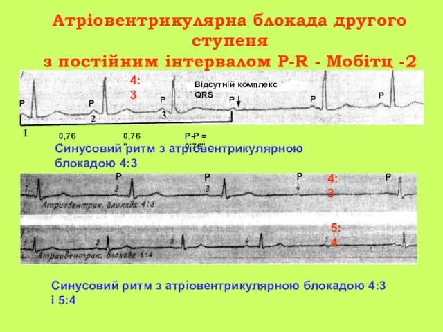 Атріовентрикулярна блокада другого ступеня з постійним інтервалом P-R - Мобітц -2