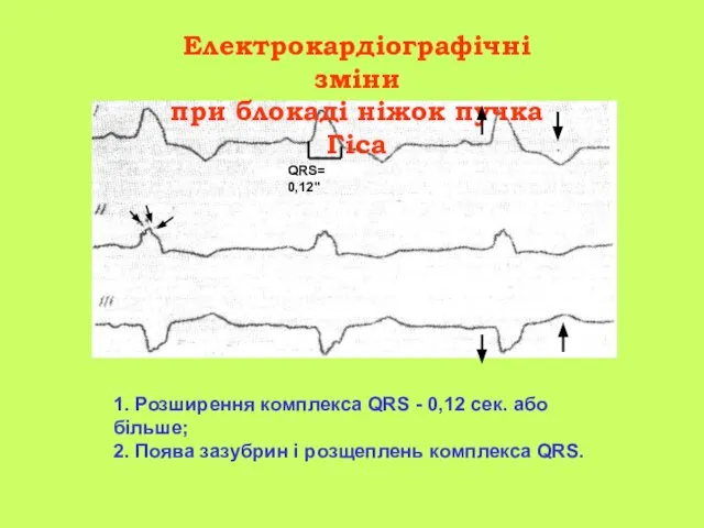 Електрокардіографічні зміни при блокаді ніжок пучка Гіса 1. Розширення комплекса QRS