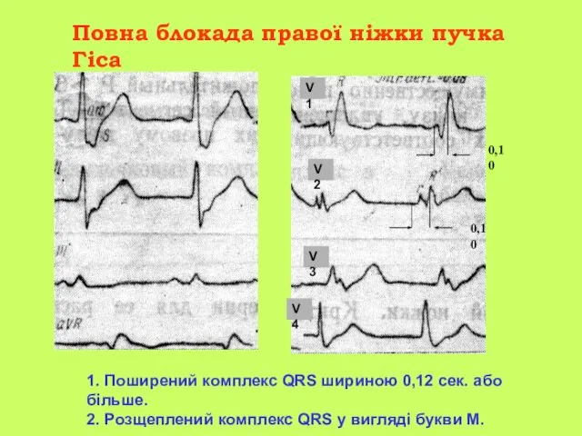 Повна блокада правої ніжки пучка Гіса 1. Поширений комплекс QRS шириною