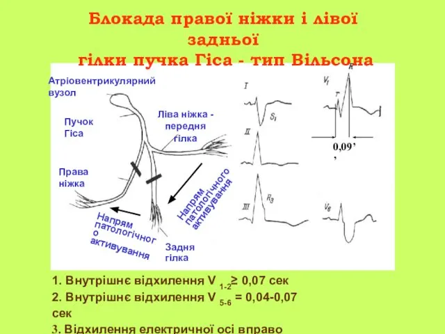 Блокада правої ніжки і лівої задньої гілки пучка Гіса - тип