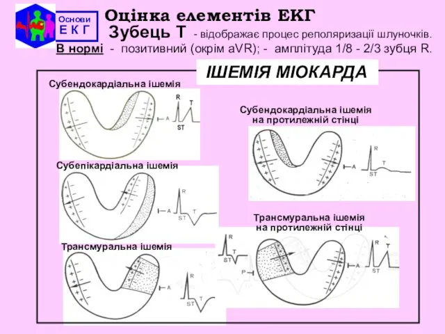 Основи Е К Г Оцінка елементів ЕКГ Зубець Т - відображає