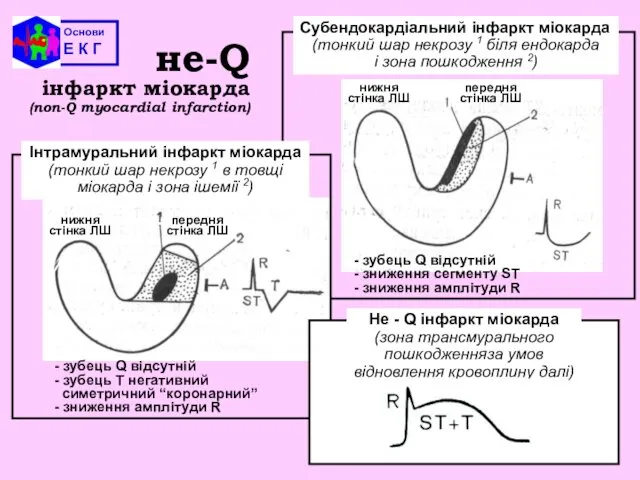 Основи Е К Г - зубець Q відсутній - зниження сегменту