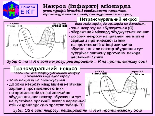 Основи Е К Г Некроз (інфаркт) міокарда (електрофізіологічні особливості поняття трансмуральний