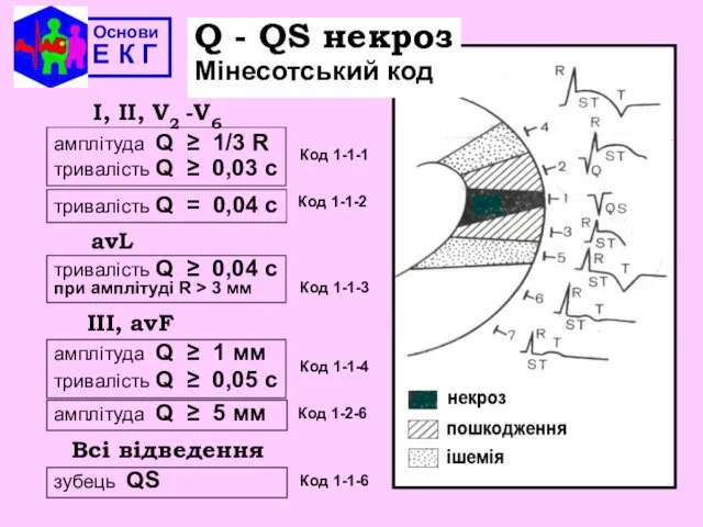 Основи Е К Г Q - QS некроз Мінесотський код амплітуда