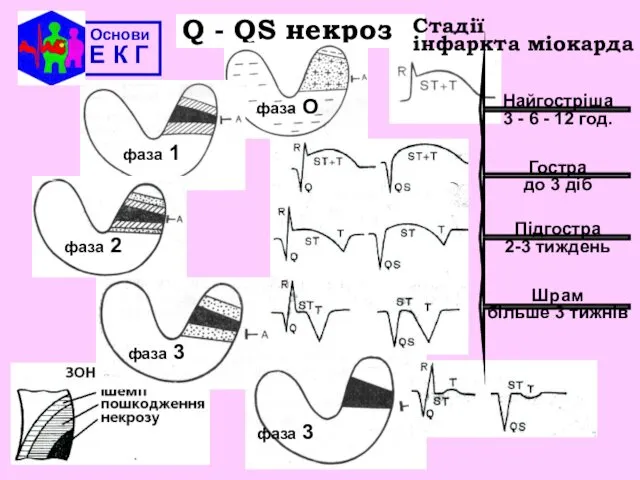 Основи Е К Г Q - QS некроз Стадії інфаркта міокарда