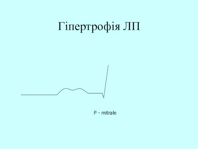 Гіпертрофія ЛП Р - mitrale