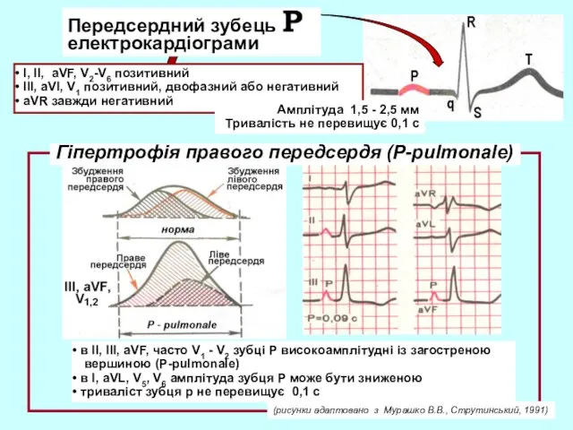 Передсердний зубець Р електрокардіограми І, ІІ, aVF, V2-V6 позитивний ІІІ, aVl,