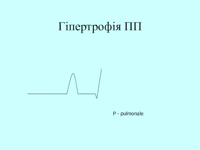 Гіпертрофія ПП Р - pulmonale