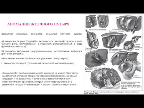 АНОМАЛИИ ЖЕЛЧНОГО ПУЗЫРЯ Выделяют несколько вариантов аномалий желчного пузыря: а) аномалии